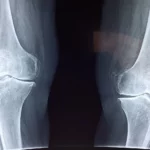 X-ray youth sports injury