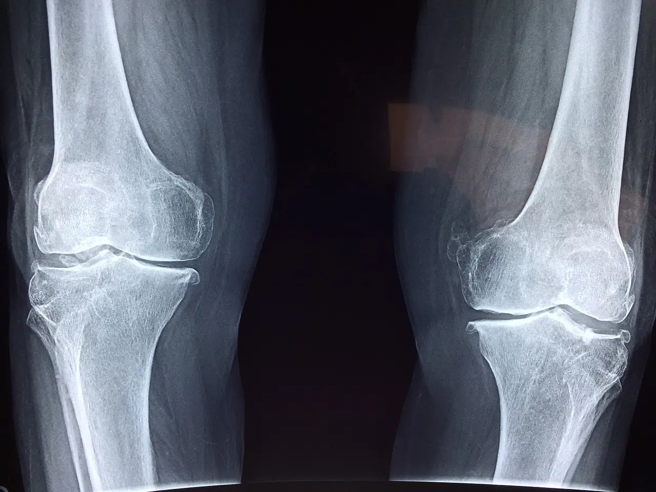 X-ray youth sports injury